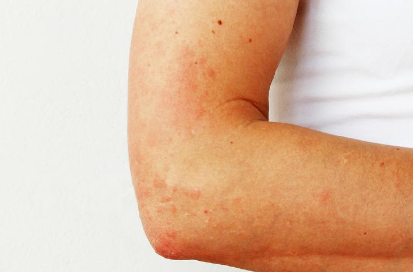 Napallergia-szezon: ezekre a tünetekre figyelj